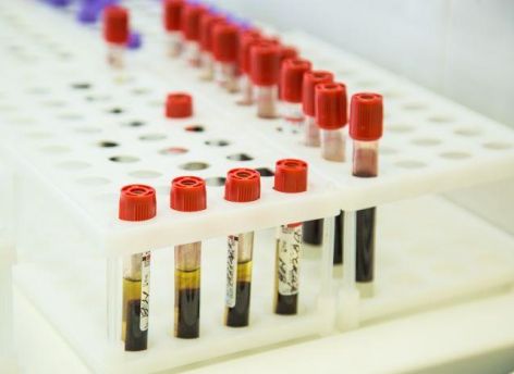 В России ВИЧ распространяется быстрее, чем в Танзании и Уганде