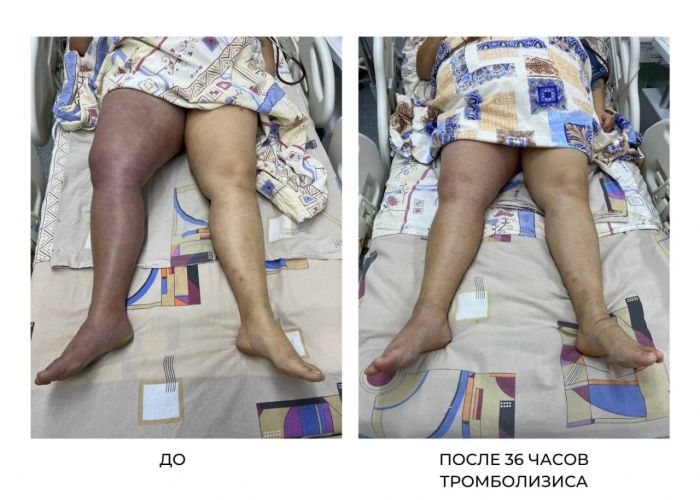 Врачи Нижневартовска прооперировали женщину с опасной венозной гангреной 