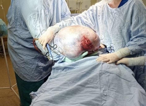 ​Жительнице Сургутского района удалили 15-килограммовую опухоль